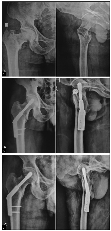 Anteroposterior and lateral images of case No 10. (a) Preoperative radiographs. (b) Postoperative radiographs. (c) Radiographs at 1 year showing union and maintained neck shaft angles.